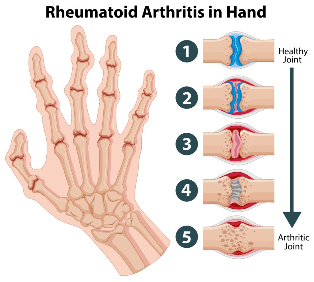 arthritis in hand